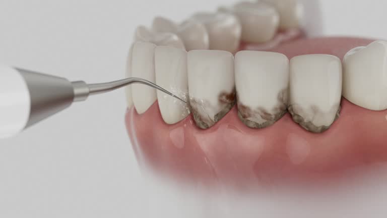 Trusted Wisdom Tooth Removal service in Atoka, OK - Dentist Open Now